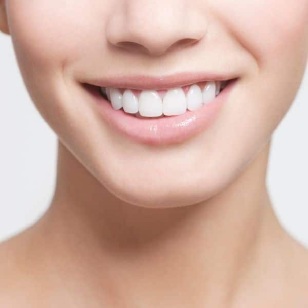 nasolabial lines treatment image