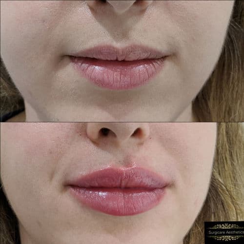 before & after lip treatment