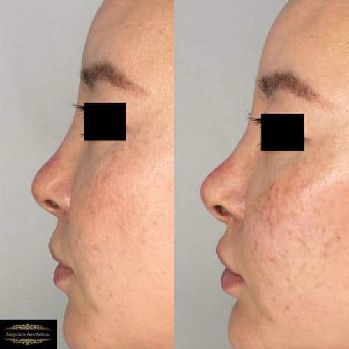 Non-surgical rhinoplasty and dermal fillers