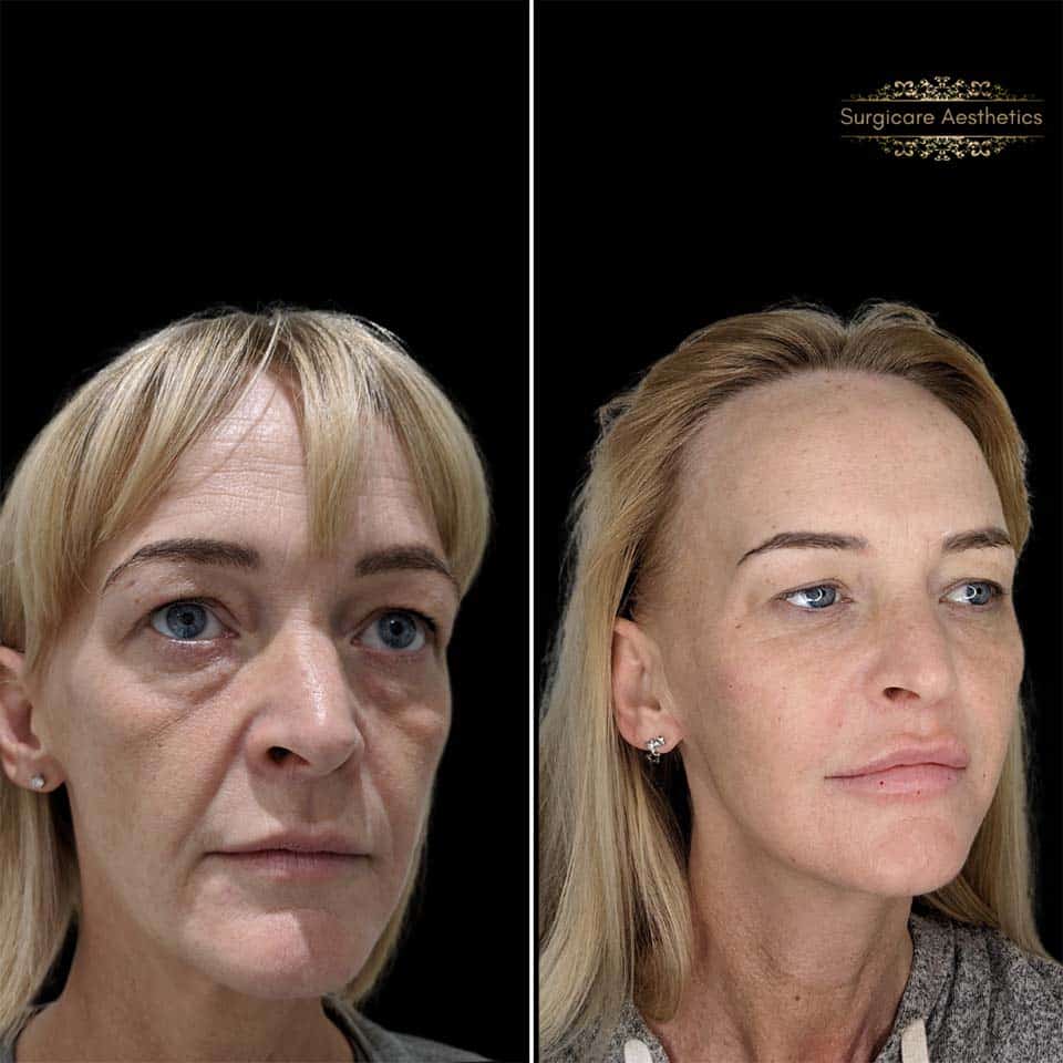 Structural Rejuvenation (3_3)